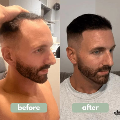 Reverse – Hair Growth Serum